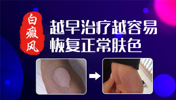 症状危害-面部长白癜风的危害有哪些